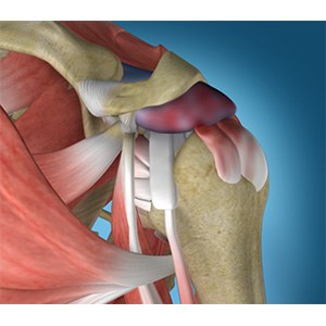 Shoulder Impingement 