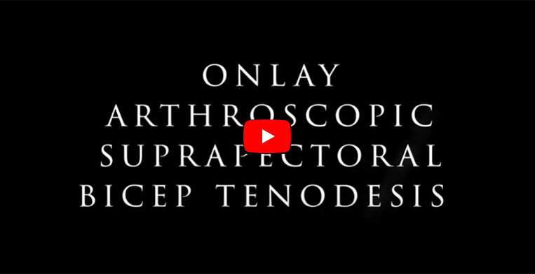 Arthroscopic Bicep Tenodesis Video